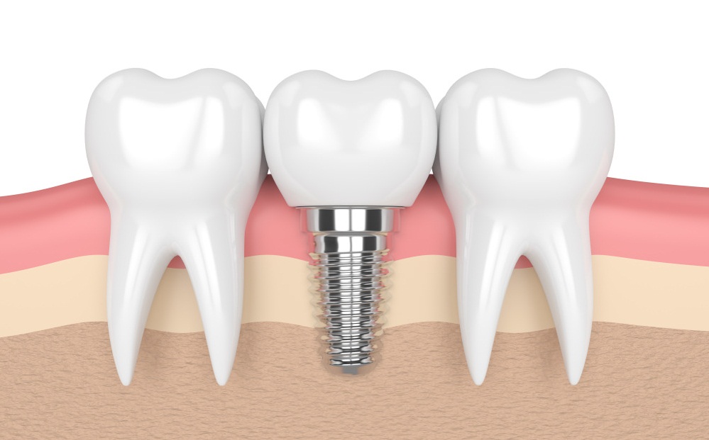 Which One Is Better? Dental Implants Or Artificial Teeth